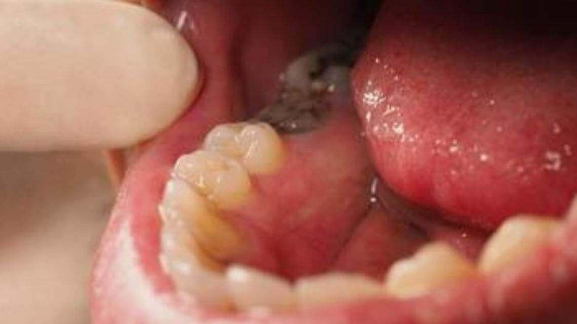 o que é carie dentaria